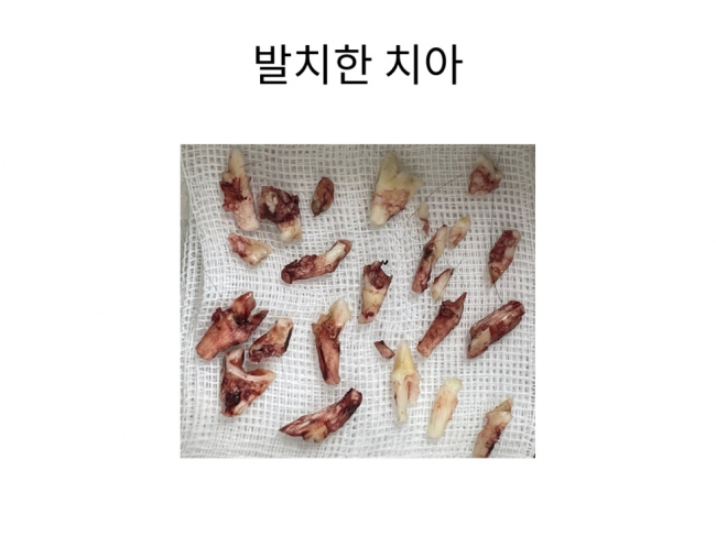 2차 전발치.jpg