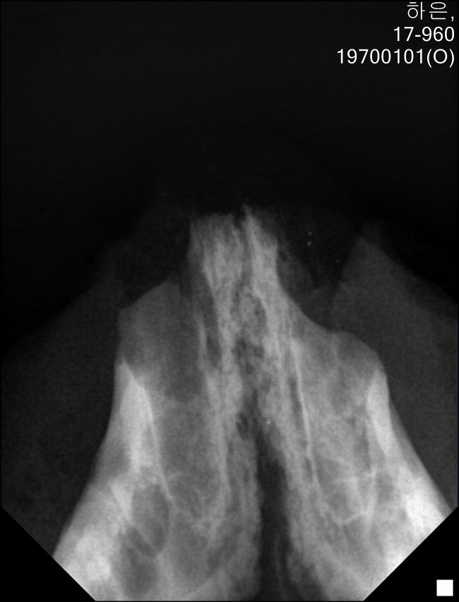 아래앞니 엑스레이.jpg